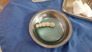 Zahnersatz Zahnbrücke beim ZahnarztChiang Rai